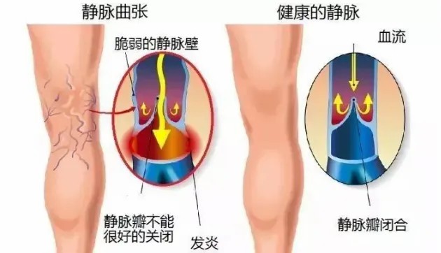 下肢静脉曲张要做什么检查？ 