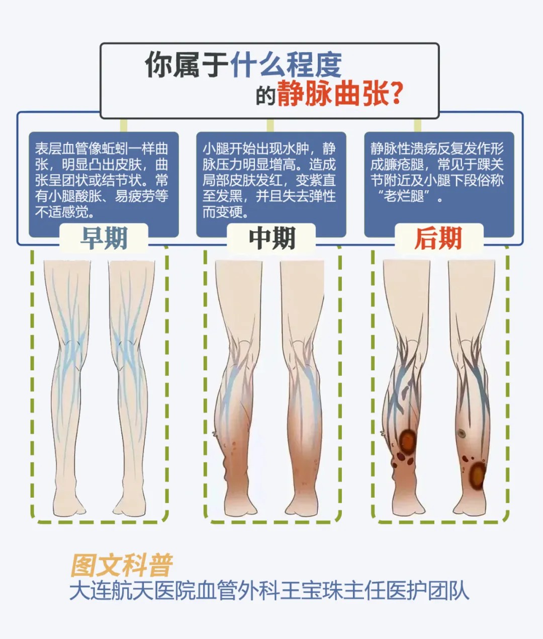 大连航天医院治疗下静脉曲张实现“即做即走” 
