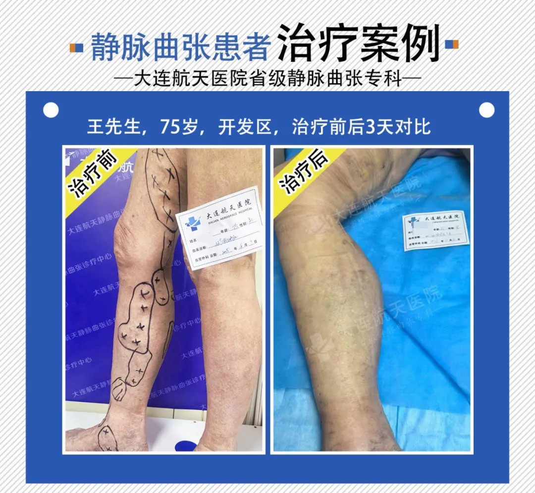 大连航天医院德国evlt微创治疗下静脉曲张实现“即做即走” (图2)