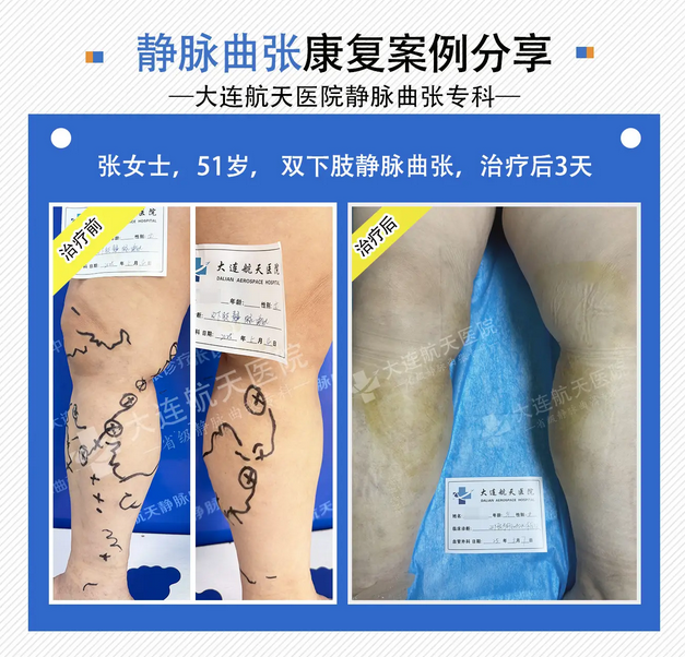 彭兴伟谈：静脉曲张患者最关心的3个问题！ 