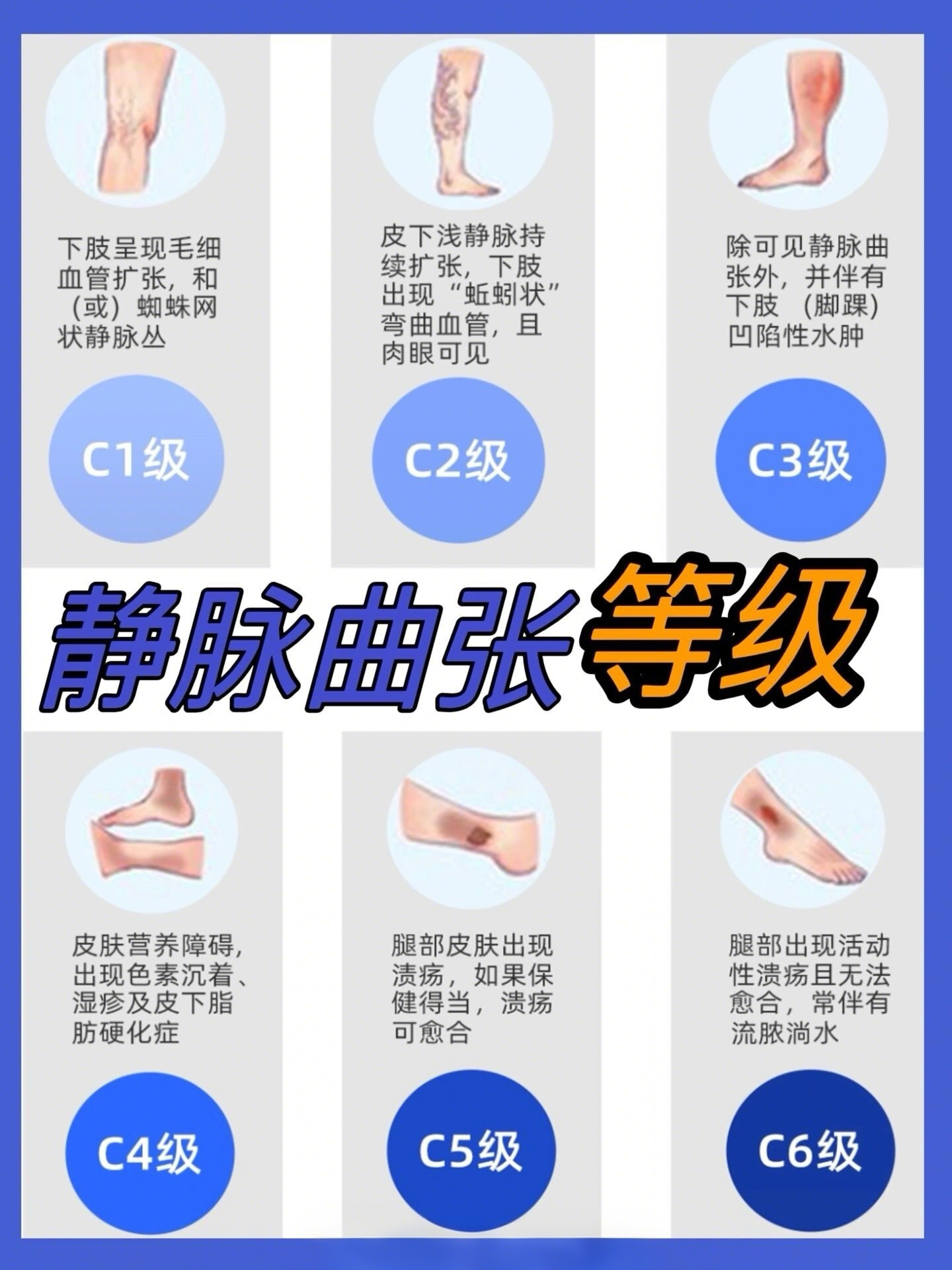 下肢静脉曲张有几个等级,下肢静脉曲张的等级划分